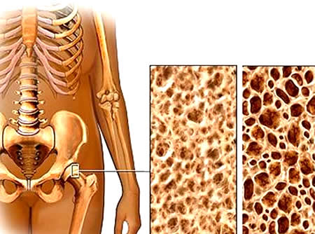 как предотвратить остеопороз